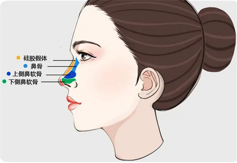 玻尿酸隆鼻后塑形期的注意事项有哪些?