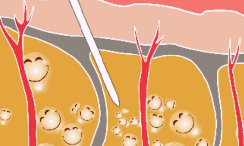 大腿抽脂要多少钱？价格因素有很多