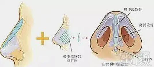 做鼻综合感染了会有什么症状?