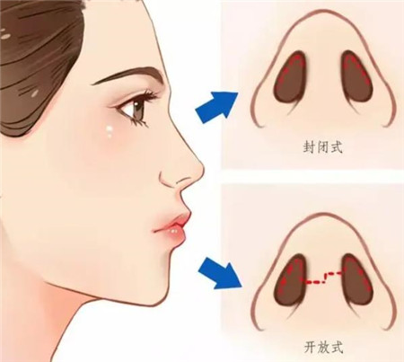 郑大一附院整形科隆鼻好不好？科室信息王喜梅医生介绍价格表