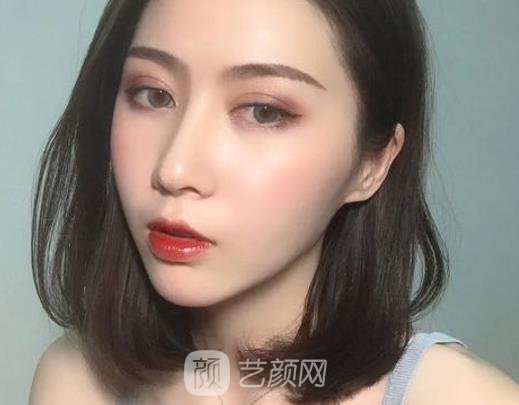 福州添媛美整形医院割双眼皮怎么样？亲身体验招牌实例分享