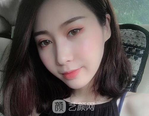 福州添媛美整形医院割双眼皮怎么样？亲身体验招牌实例分享