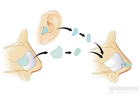 鼻小柱在哪里，延长鼻小柱的方法有哪些