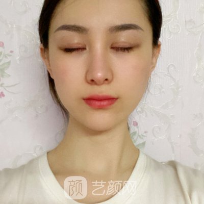 长沙美莱刘欢做鼻子怎么样？全新实例曝光