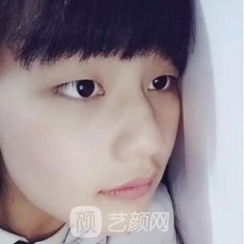 厦门美莱医疗美容医院割双眼皮怎么样？医生简介+实例