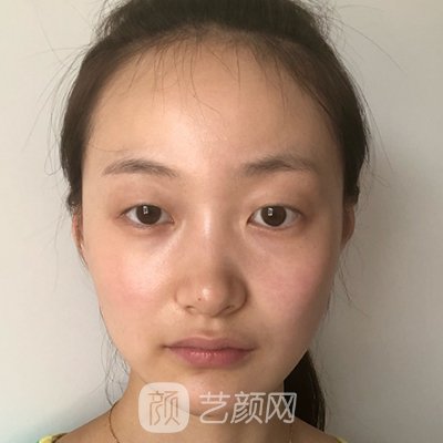 张家港颜图医美双眼皮怎么样？亲身体验实例分享