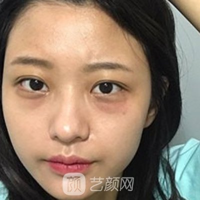 武汉美妍高科医疗美容去眼袋的价格贵吗？官网价格表及实例出炉