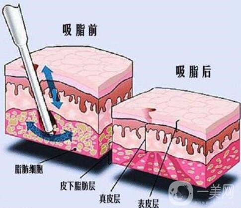 负压吸脂术的手术方法？有哪些优势？