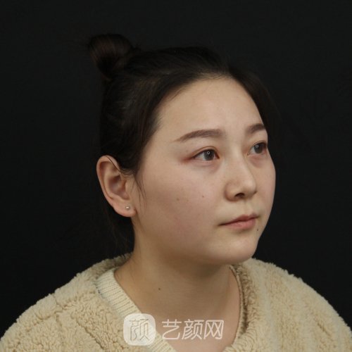 福州格莱美周秀峰做鼻子怎么样？全新体验实例出炉