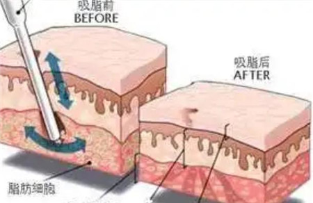 腰椎吸脂术有什么作用，切口有几种