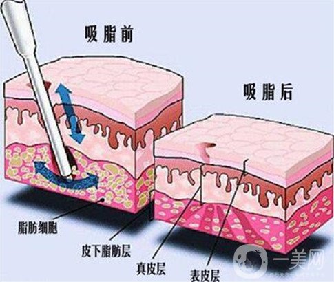 抽脂有哪些方法？能瘦几斤