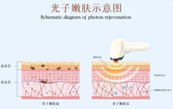 光子嫩肤的原理和优势有哪些？适应人群分析