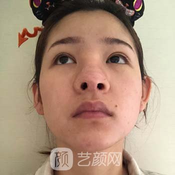 成都张小虎修复鼻子怎么样？医生个人简介+修复鼻子实例鉴赏