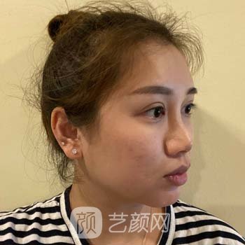 成都李萍做鼻子怎么样？耳软骨隆鼻真人实例对比图