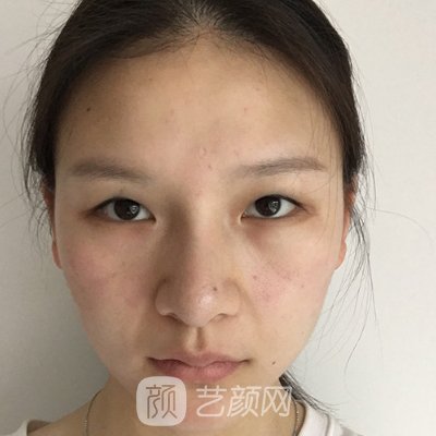 长春光泽爱美汇美容院做双眼皮多少钱？全新收费标准及实例出炉