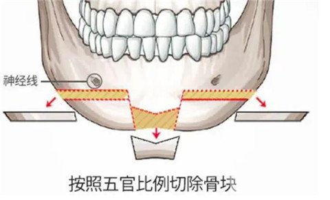 颧骨磨骨失败有哪些表现？有什么方法可以改善颧骨突出