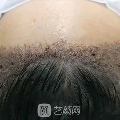 苏大附二院植发怎么样？医院招牌实例及成果图出炉