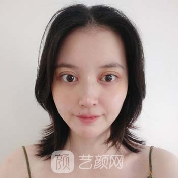 翟奔宇的技术怎么样？医生简介+双眼皮整形实例