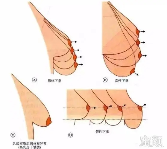 什么情况适用乳房下垂悬吊术?