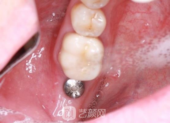 南宁岭南口腔医院种植牙价格曝光｜内附亲身体验实例