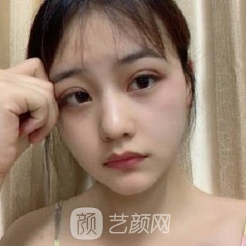 沈阳杏林张莹莹双眼皮实例，术后五官比例得到增强