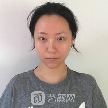 友谊整形医院张婉婷医生怎么样？医生简介+双眼皮实例