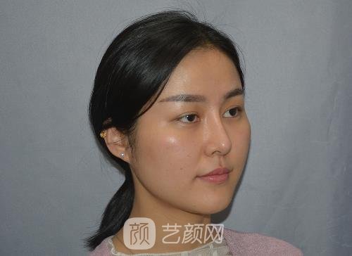 温州德尔美客医疗美容诊所双眼皮实例出炉｜内附体验成果图