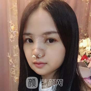 广州华美张明兴做的鼻子怎么样？医生简介+肋骨鼻实例