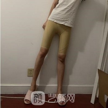 艺美王东做脂肪怎么样？价格是多少？大腿吸脂实例分享