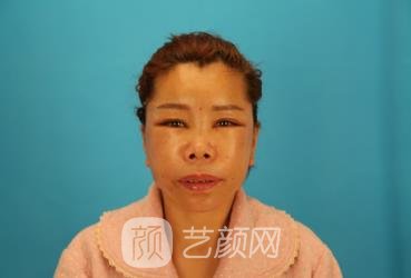 吴亚龙医生做拉皮怎么样？小切口拉皮真人案例更新