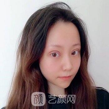 成都侯典举双眼皮做得怎么样？医生简介+双眼皮真人实例更新