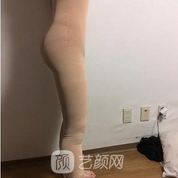 北京润美玉之光朱金成怎么样？医生简介+大腿吸脂实例