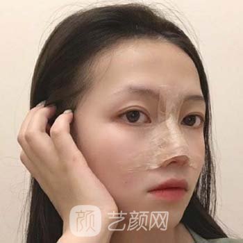 广州特壹美医疗美容做鼻子怎么样？附真人隆鼻实例对比图片