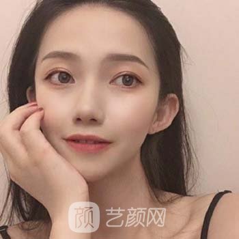 广州特壹美医疗美容做鼻子怎么样？附真人隆鼻实例对比图片