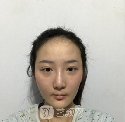 蒋思军双眼皮修复实例,修复之后美貌度和气质双重提升