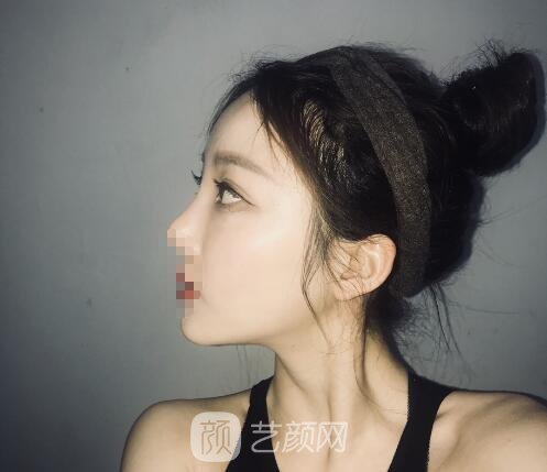 蒋思军双眼皮修复实例,修复之后美貌度和气质双重提升