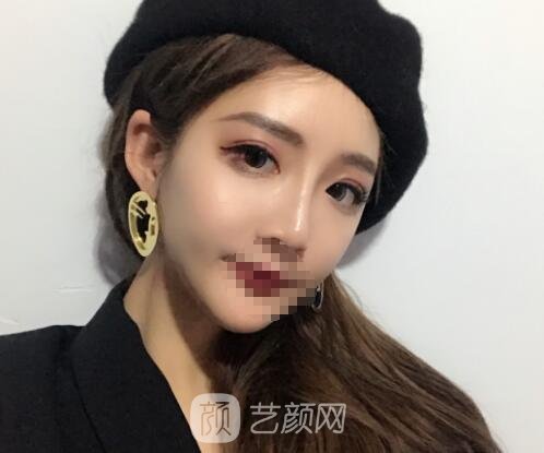 蒋思军双眼皮修复实例,修复之后美貌度和气质双重提升