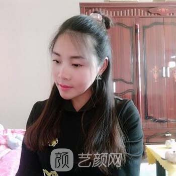 李志海做的下颌角实例，手术前后修复图片展示