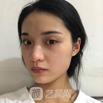 长沙安吉娜做双眼皮怎么样？多少钱？医生介绍+案例图