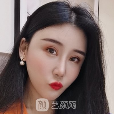 上海沪美人整形医院正规吗？2022双眼皮案例曝光