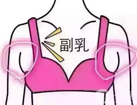 副乳切除后会复发吗？有什么风险？