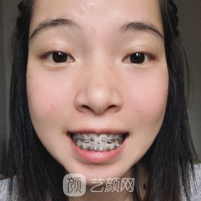 上海科美口腔门诊部牙齿正畸案例出炉｜内附体验效果图