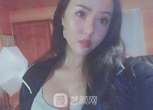 南京连天美脂肪隆胸实例公开｜成果自然无痕