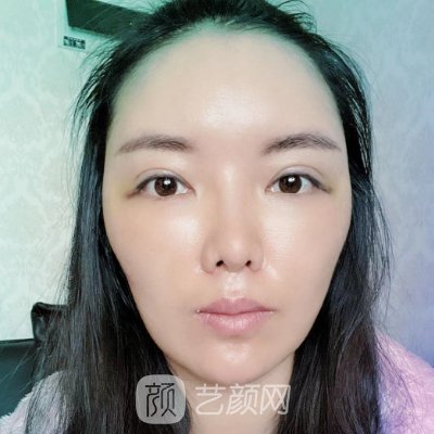 南京美贝尔美容医院正规吗？全新面部脂肪填充实例出炉