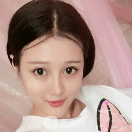 北京玉之光整形医院玻尿酸面部填充成果图展示|附体验感悟