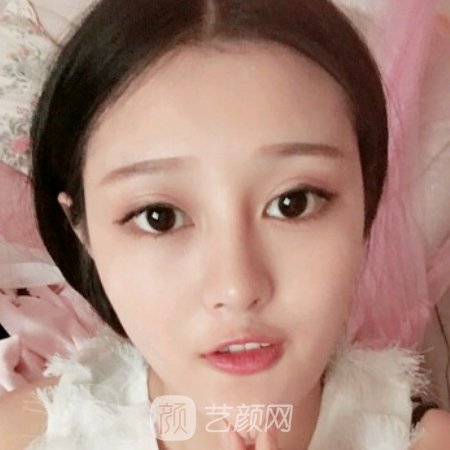 北京玉之光整形医院玻尿酸面部填充成果图展示|附体验感悟