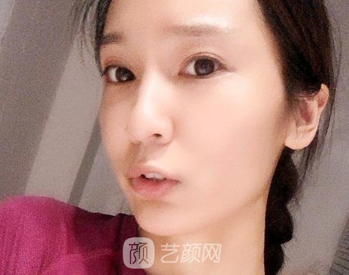 南京连天美整形医院玻尿酸面部填充实例出炉｜附体验对比图