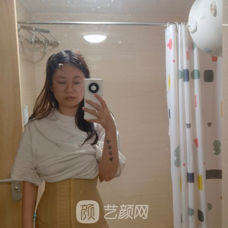 东莞壹加壹整形医院吸脂实例展示｜附亲身体验对比图