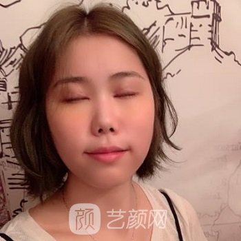 刘辅容双眼皮修复实例，术后90天成为元气女神