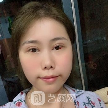 刘辅容双眼皮修复实例，术后90天成为元气女神